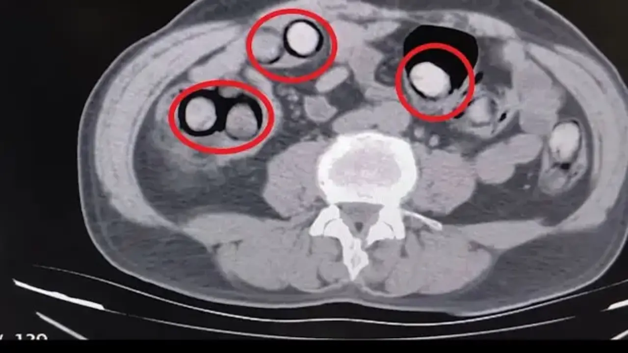 Midesinden çıkan şoke etti! 758 gram uyuşturucuyla yakalandı
