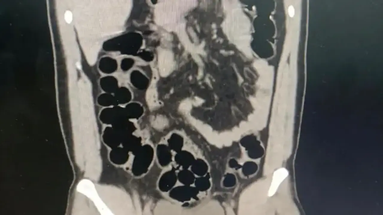 Midesinden kapsüller içinde 943 gram eroin çıktı