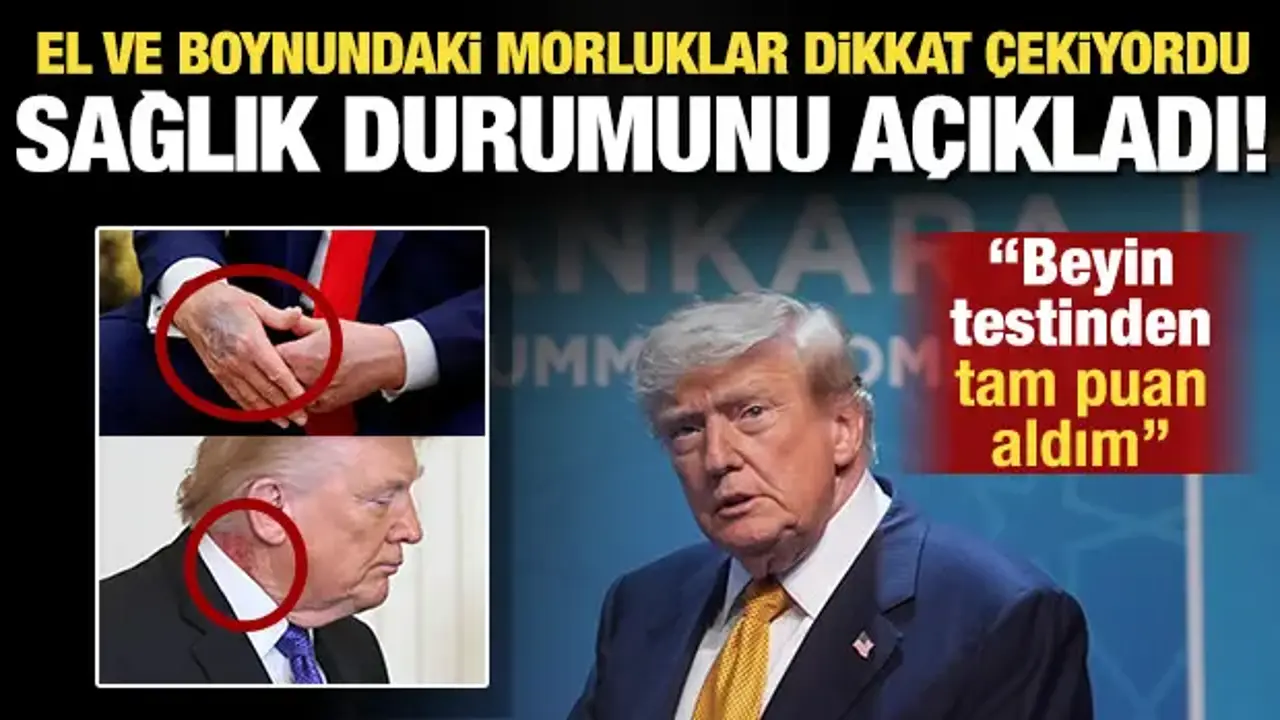 Trump'ın sağlık durumu nasıl? Boynundaki morluklar dikkat çekmişti: 'Tam puan aldım'