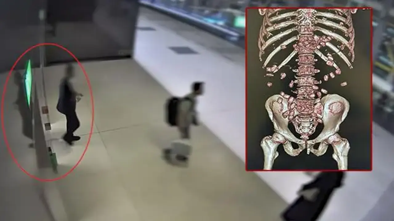Yürümekte zorlanınca yakayı ele verdi! Midesinde tam 26 kapsül uyuşturucu çıktı!